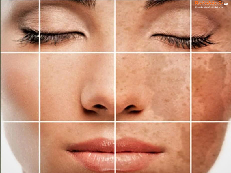 da mặt bị sạm đen là bệnh lý rất thường gặp