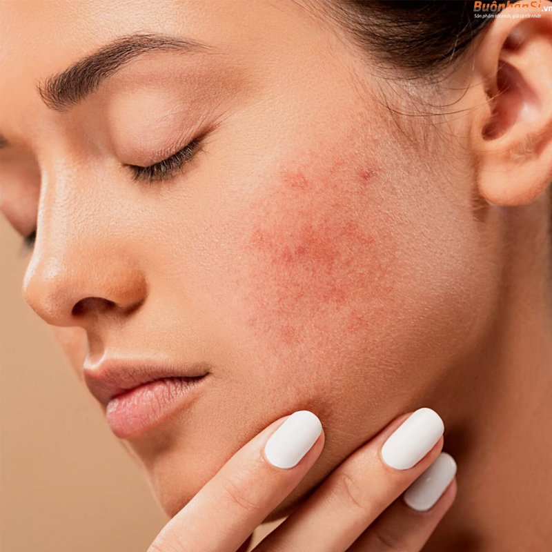 Sự thật về công dụng của Biotin đối với da? Có gây mụn hay không? 4 biotin đối với da