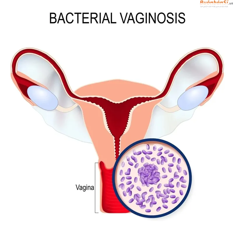 viêm âm đạo do vi khuẩn BV